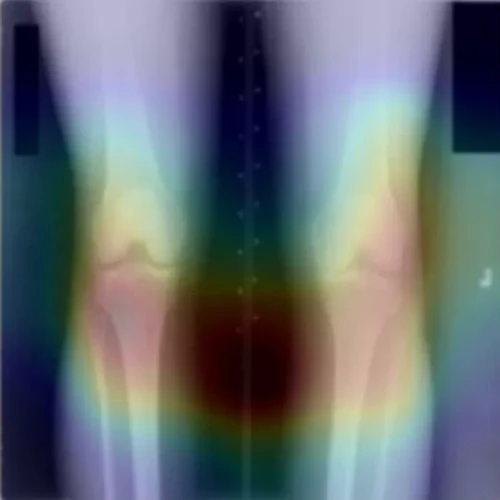 Researchers at Dartmouth Health used X-rays of knees, along with dietary surveys, to 'teach' AI software how to detect beer consumption.