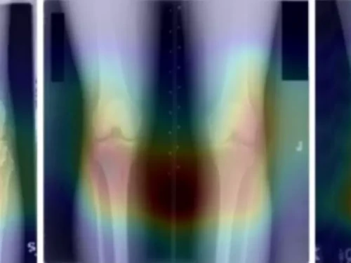 Researchers at Dartmouth Health used X-rays of knees, along with dietary surveys, to 'teach' AI software how to detect beer consumption.